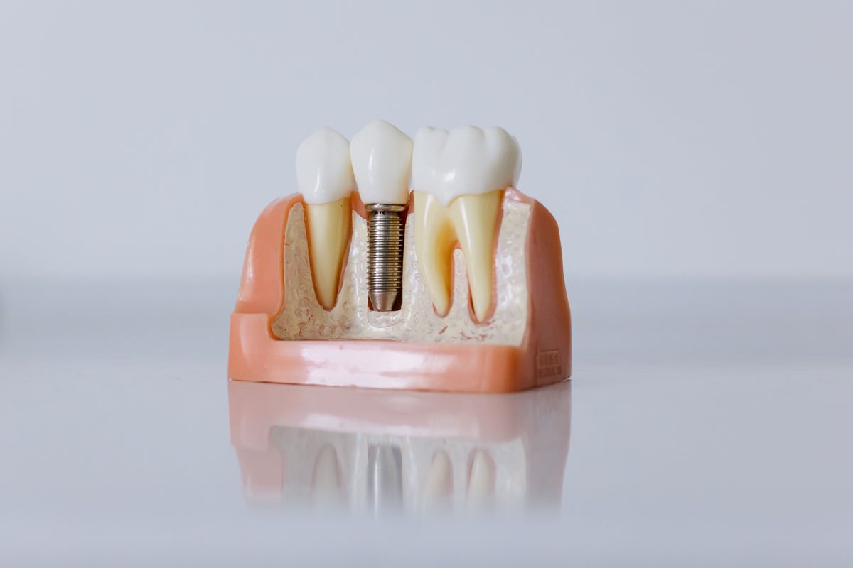 Detailed dental implant model showcasing teeth structure for educational purposes