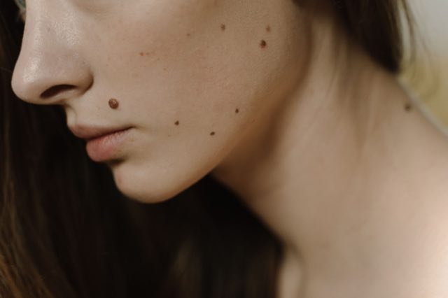 Dermatologist examining a patient's skin