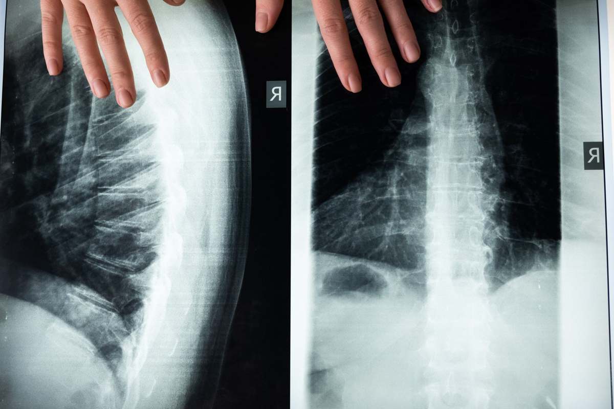 A close-up of a spine X-ray being reviewed