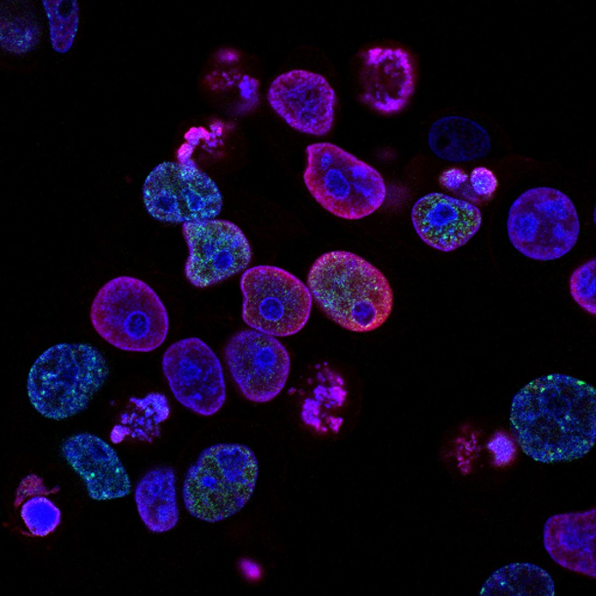 Fluorescently stained tumor cells under the microscope