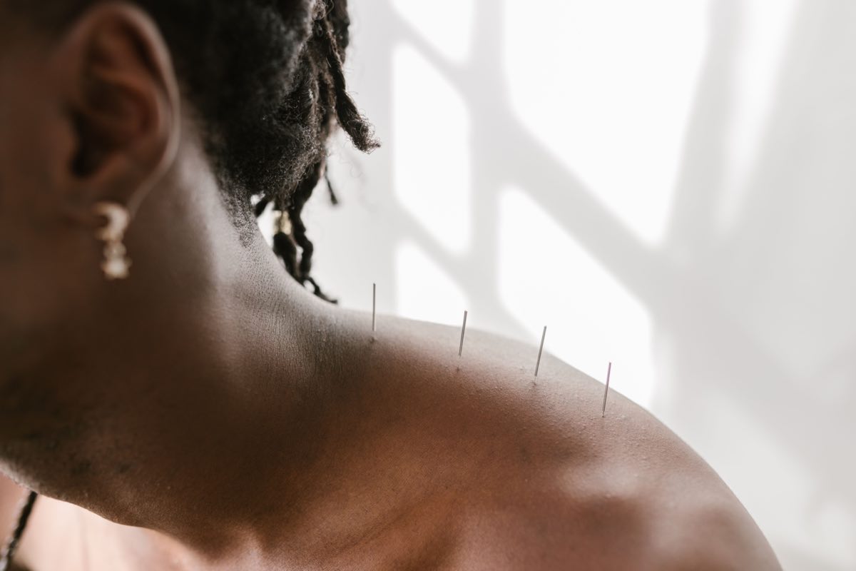 Detailed view of acupuncture needles applied to a shoulder for therapeutic treatment