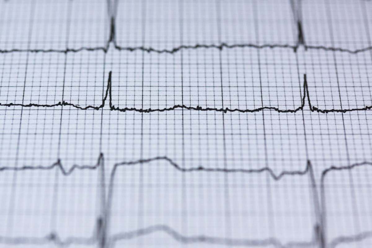 A close-up of an ECG reading on graph paper