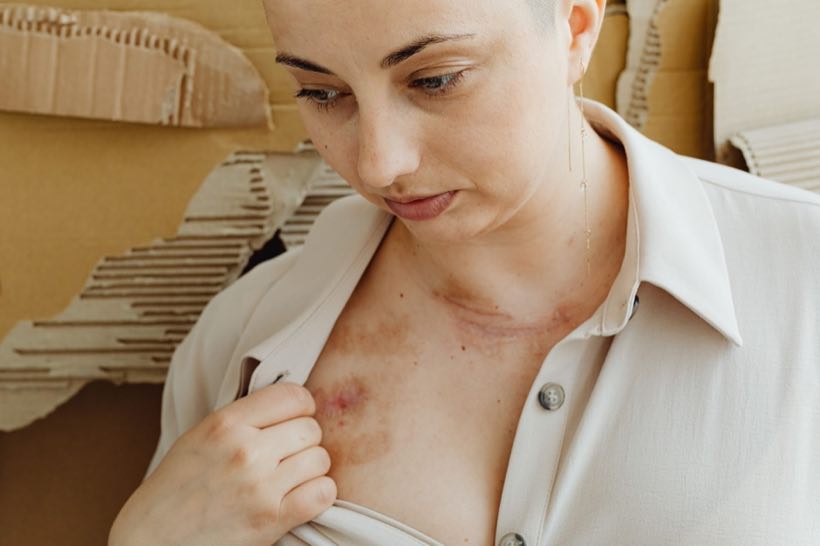Patient showing a dermatologic condition at the collarbone