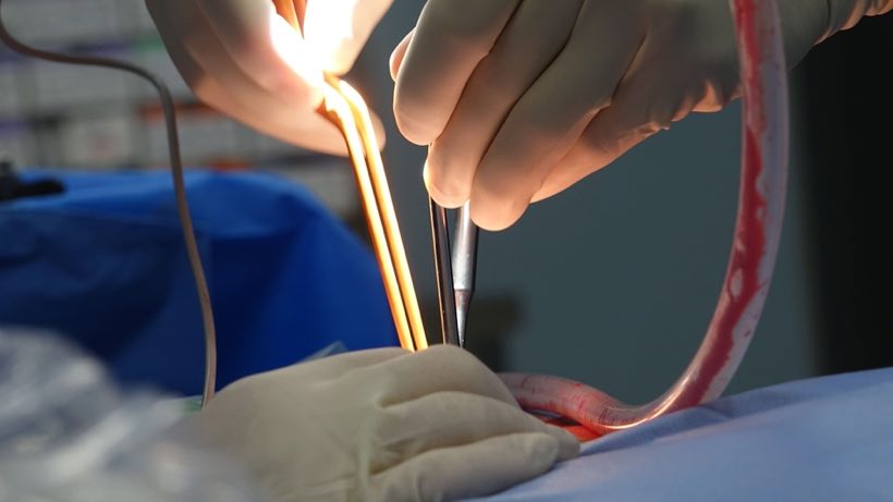 Close-up of a surgeon operating in a sterile environment using surgical instruments